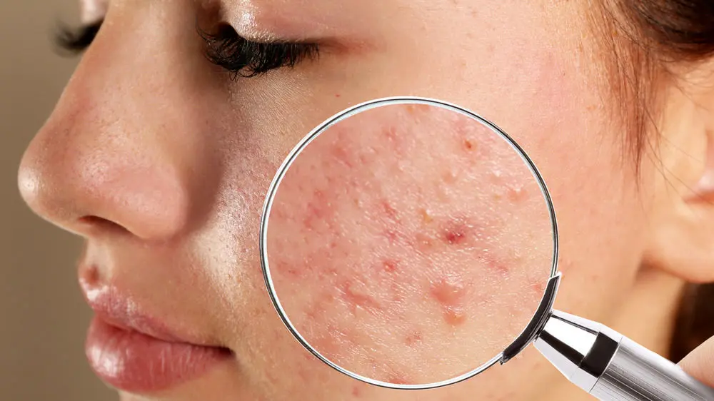 چه کار کنیم که جوش نزنیم؟