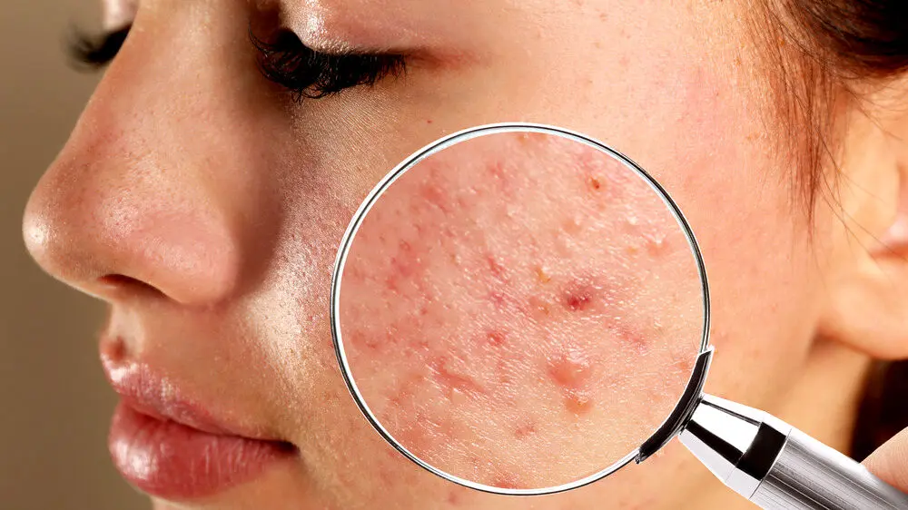 چه کار کنیم که جوش نزنیم؟