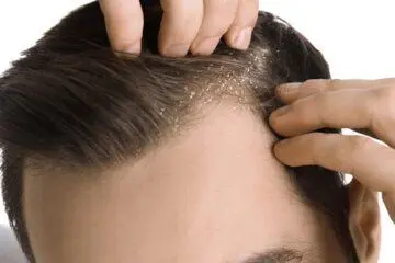 رفع شوره سر با مصرف این غذاها