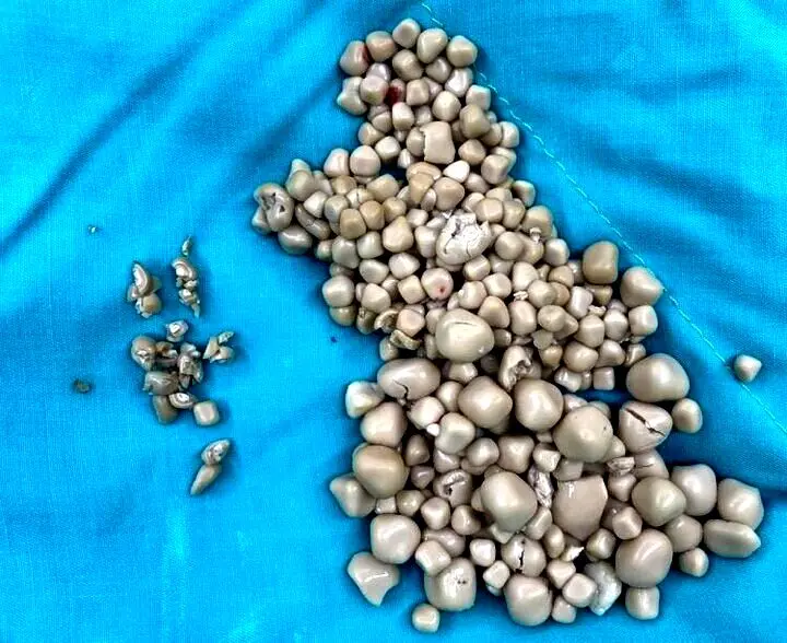 کشف معدن سنگ از بدن یک دختر ۲۰ ساله!