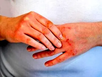 بیماری اگزما چیست و چگونه درمان می‌شود؟