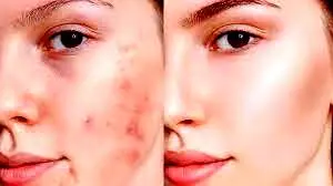 آیا استفاده از خمیردندان برای از بین بردن جوش صورت موثر است؟