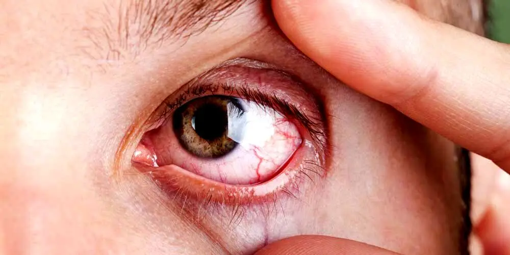 اگر خشکی چشم دارید این کارها را اصلا انجام ندهید